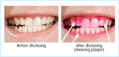 using-plaque-disclosing-tablets