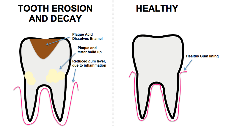diagram-of-tooth-erosion