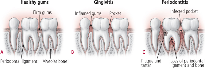 Periodontal-disease