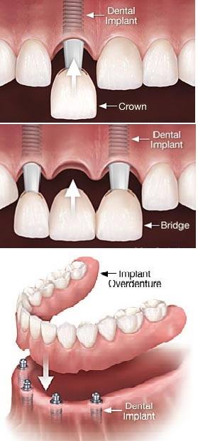 implant-denture