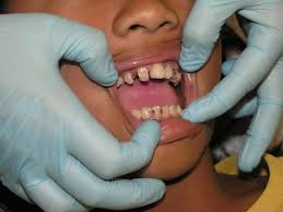 tooth-decay