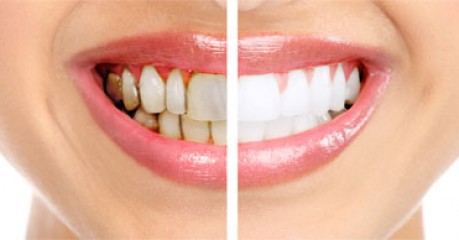gum-3