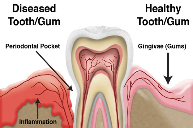 gum