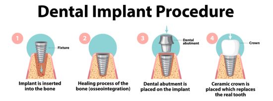 Dental Implants